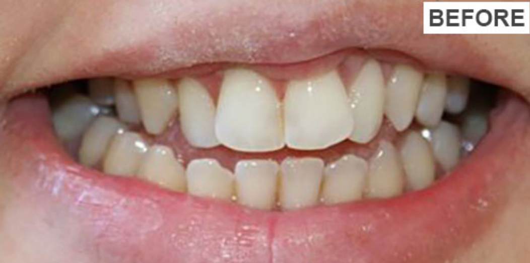 Before teeth whitening treatment showing yellow and stained teeth at Gupta Dental Panchkula