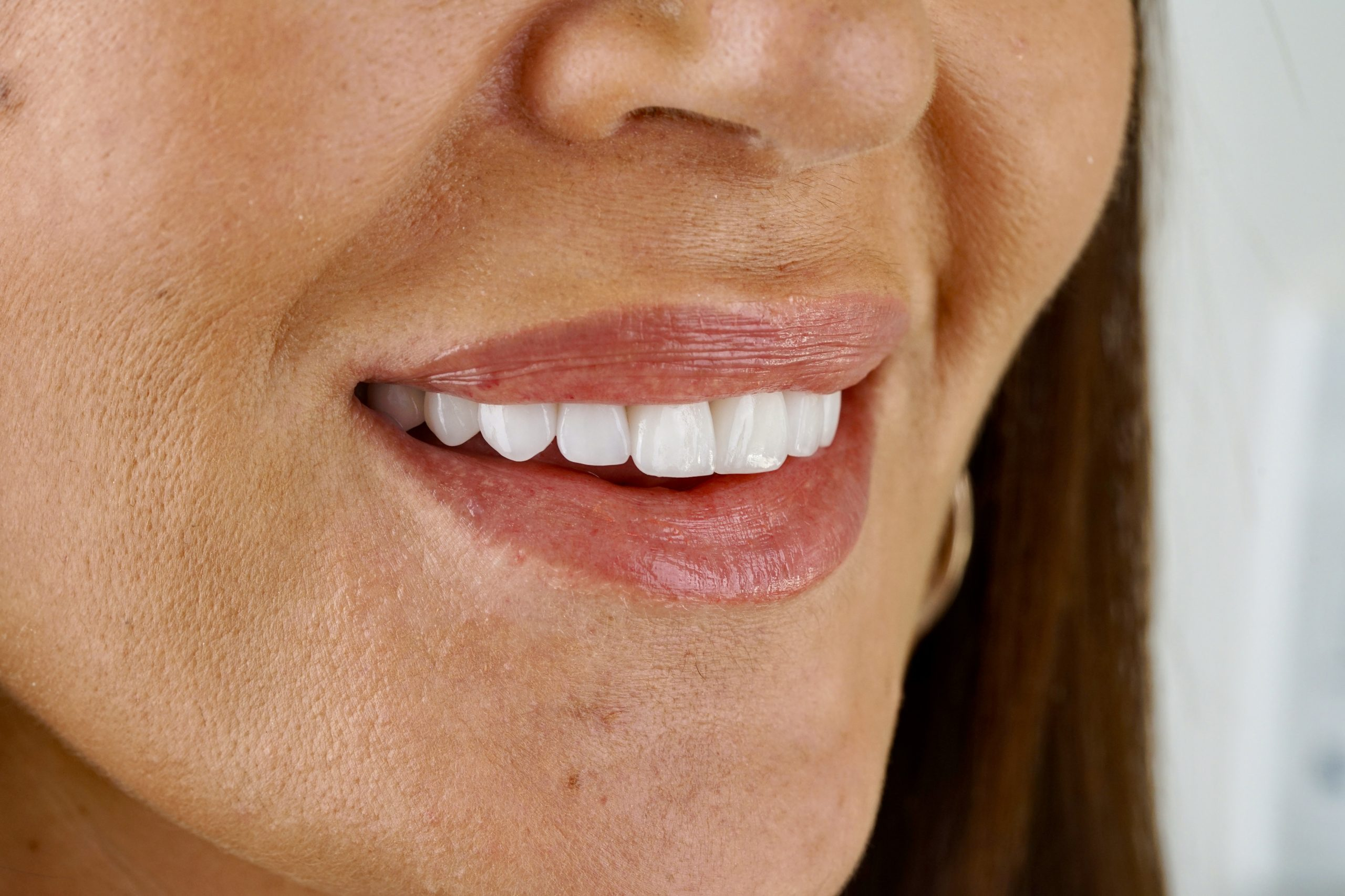 Dental implant procedure at Gupta Dental Hospital Chandigarh showing high quality implant placement