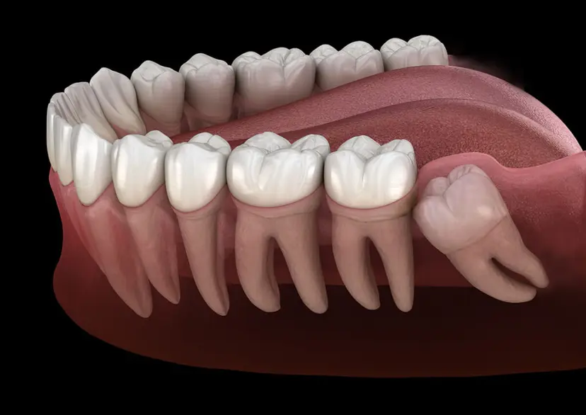 Safe wisdom tooth extraction surgery at Gupta Dental Hospital Chandigarh
