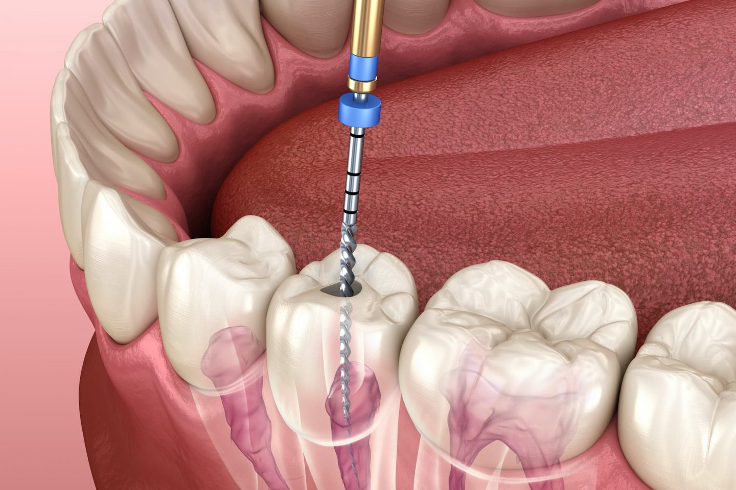 Painless root canal treatment using advanced rotary endodontics at Gupta Dental Chandigarh